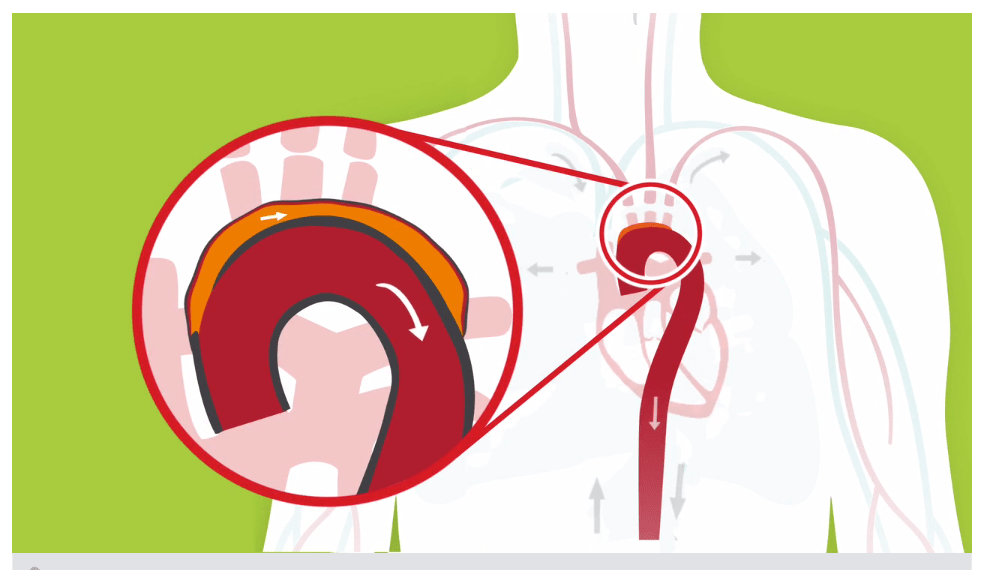  Aorta - notiuni de anatomie